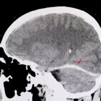Can a Hypoxic Brain Injury Occur After a Car Accident?